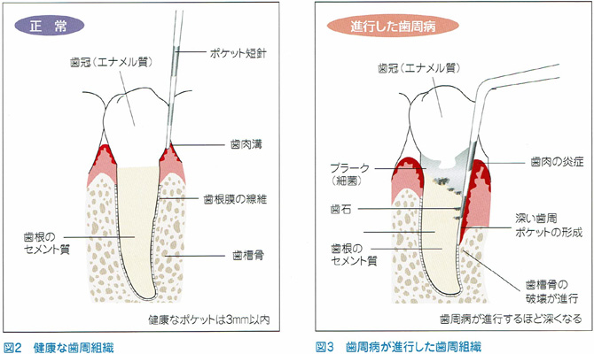 健康な歯周組織の図と歯周病が進行した歯周組織の図