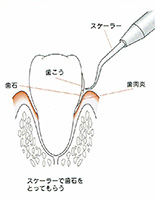 歯石取りの図