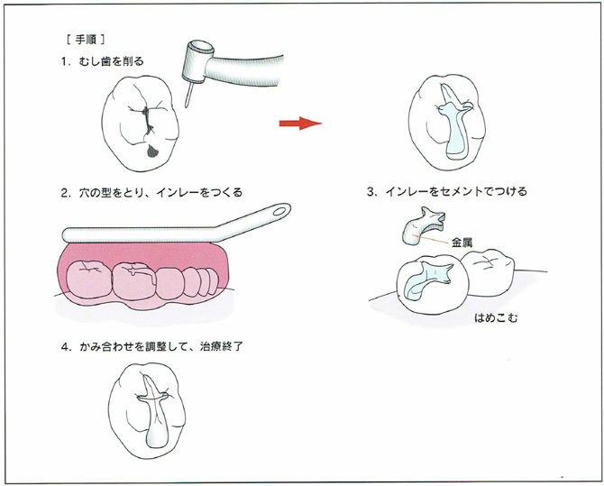 ②修復の手順
