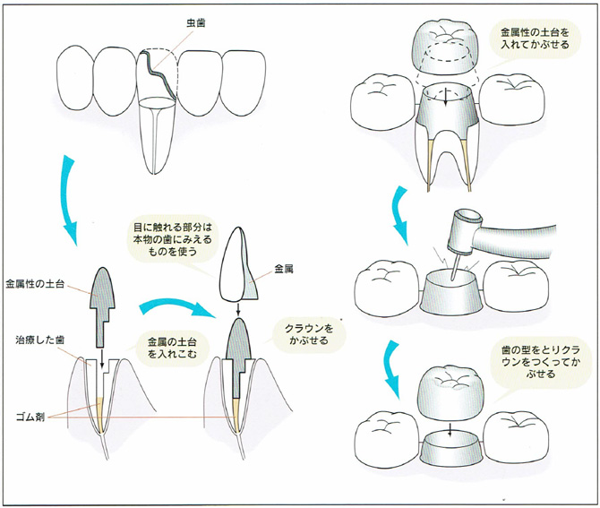 ②クラウンの手順