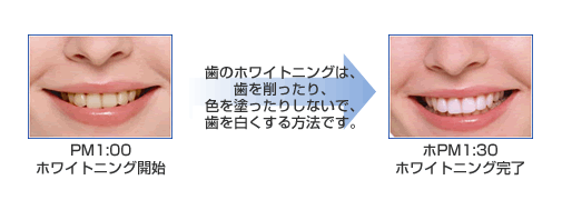 歯のホワイトニングは歯を削ったり、色を塗ったりしないで歯を白くする方法です。